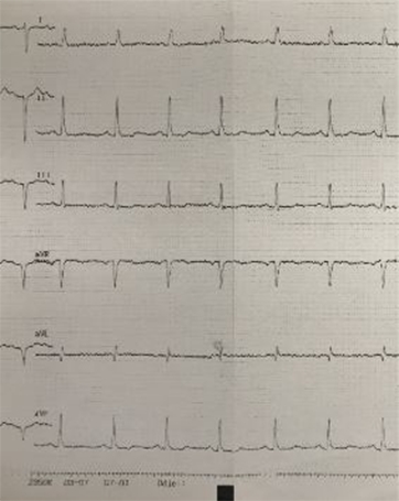 EKG