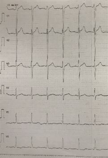 EKG